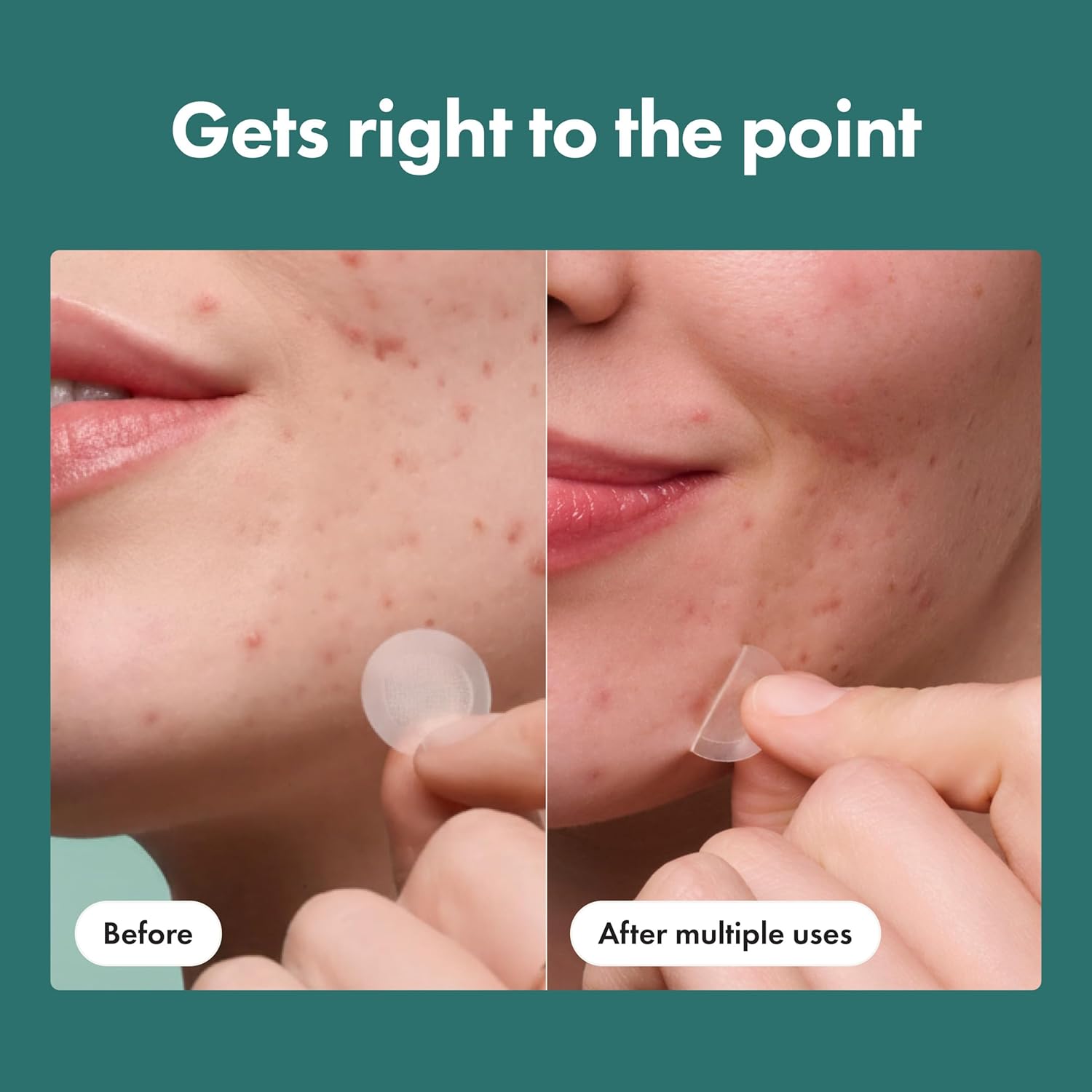 Hero Cosmetics Mighty Patch Micropoint for Blemishes – 8 Count